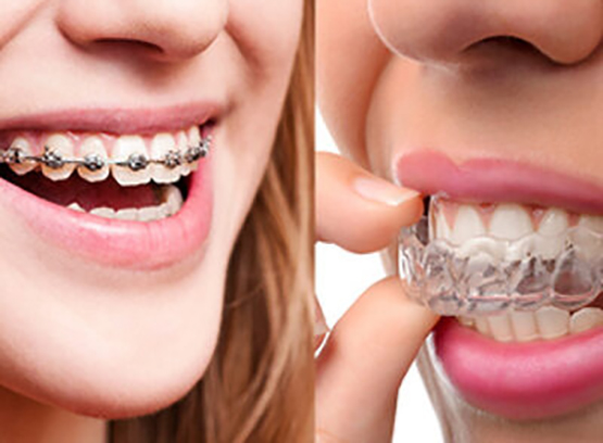 Ortodonzia classica ed estetica