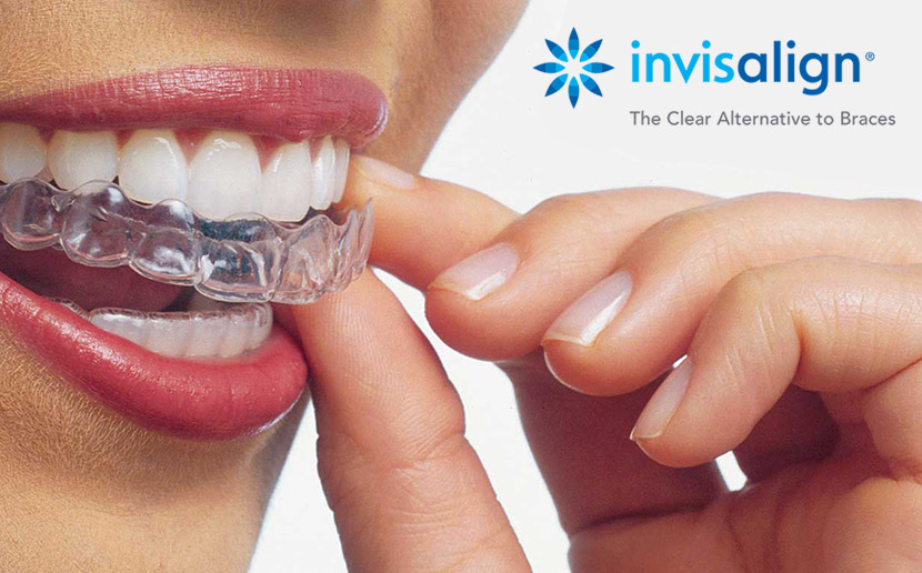 Invisalign ortodonzia estetica